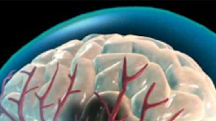 Accidente cerebrovascular Accidente cerebrovascular
