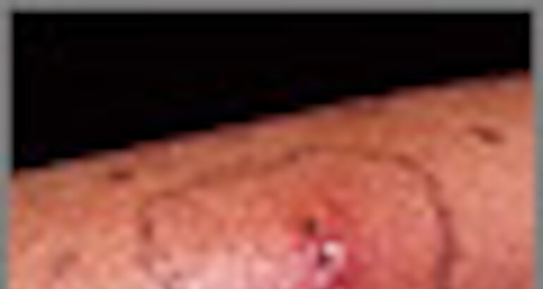Celulitis